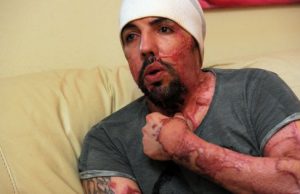 Sfigurato dall’acido, William Pezzullo vuole vedere Salvini