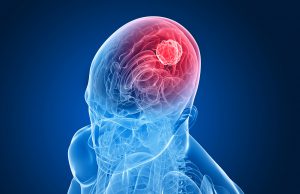 Tumori al cervello: a Brescia 100 casi all’anno