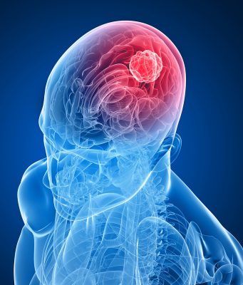 Tumori al cervello: a Brescia 100 casi all’anno
