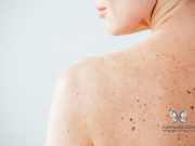 Melanoma: visite gratis di prevenzione in Poliambulanza