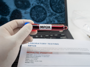 Vaiolo delle scimmie, Bertolaso: “Nessun caso con variante tipo I”