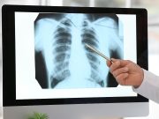 Dal 2025 in Lombardia parte lo screening del tumore al polmone