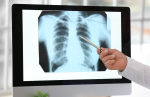 Dal 2025 in Lombardia parte lo screening del tumore al polmone