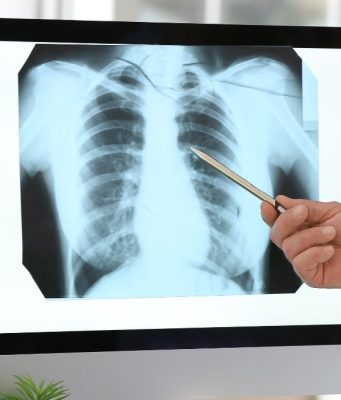 Dal 2025 in Lombardia parte lo screening del tumore al polmone